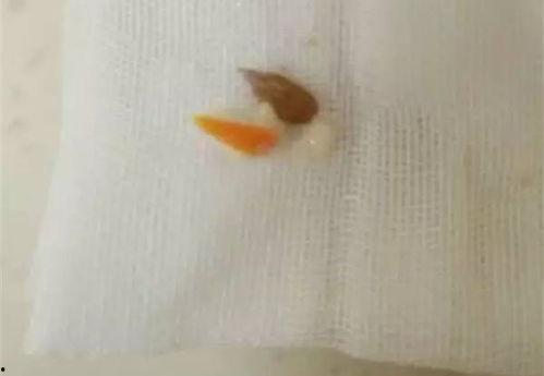 吃瓜卡到气管,揭秘吃瓜卡喉的紧急应对