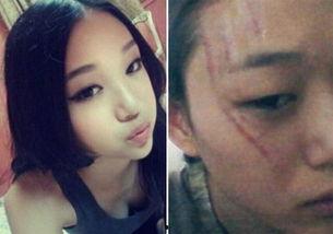 明星烧伤毁容图片,揭开演艺圈背后的伤痛与挑战