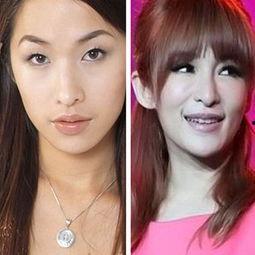 明星失败双眼皮图片,美丽蜕变需谨慎